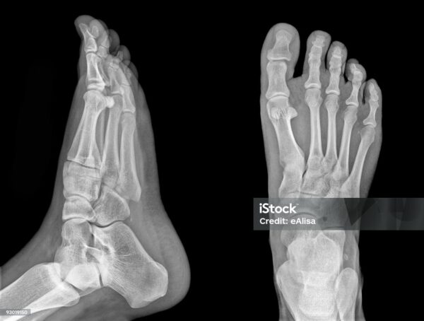 x ray foot