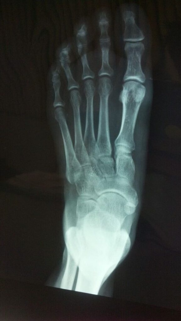 foot x-ray